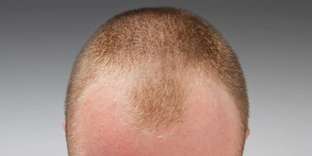 How To Thicken Men's Hair Naturally (Thinning Hair in Men) & VITAMAN USA