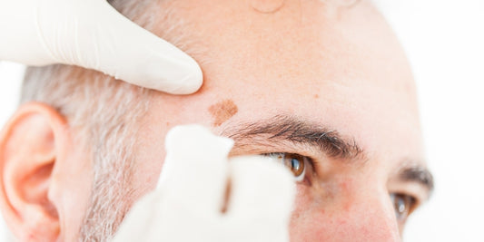 how to stop men's age spots