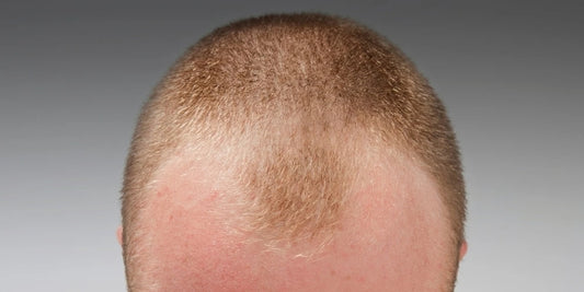 how to stop thinning hair